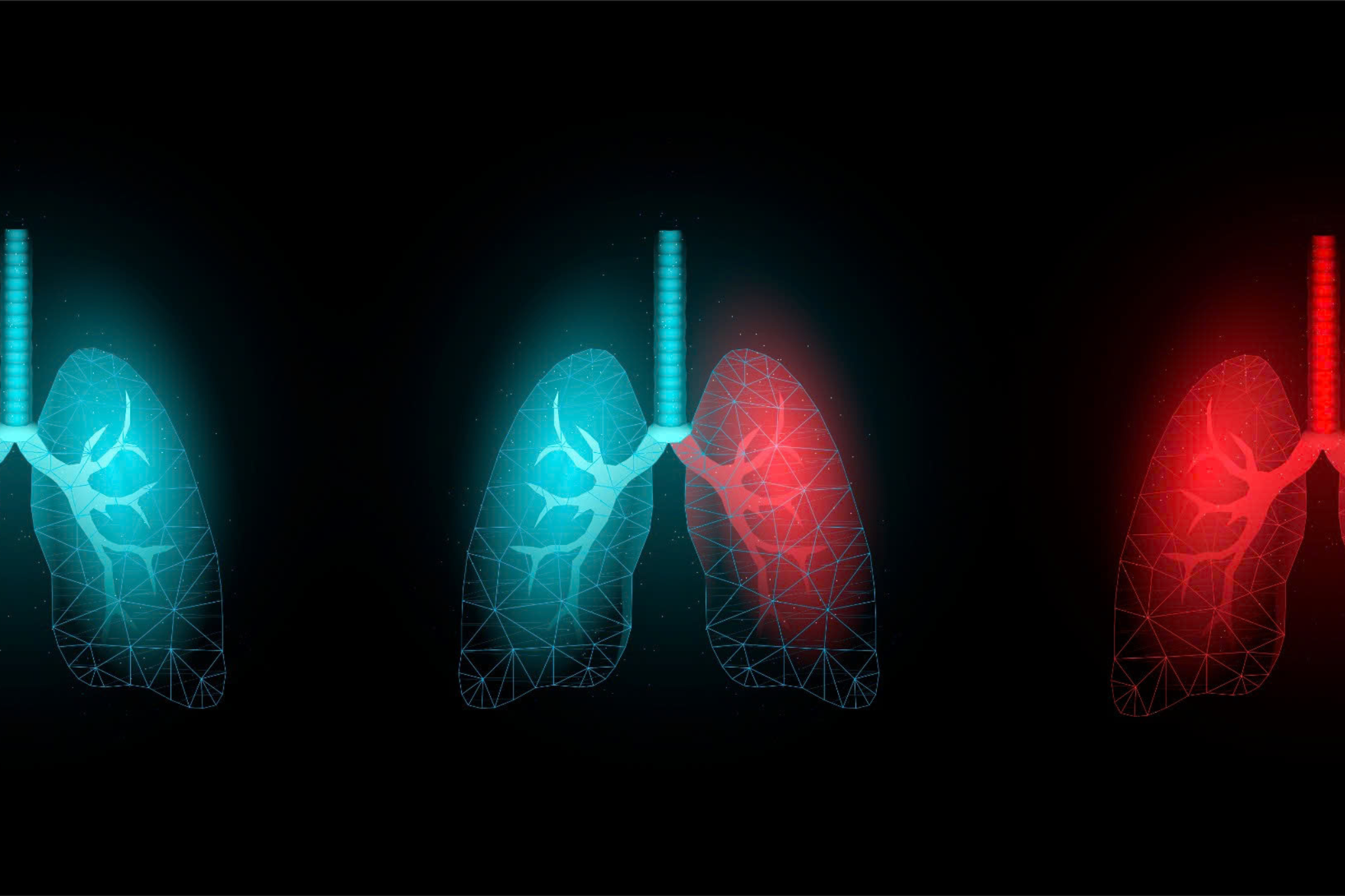 CovidXray - Chẩn đoán Covid từ ảnh X-quang